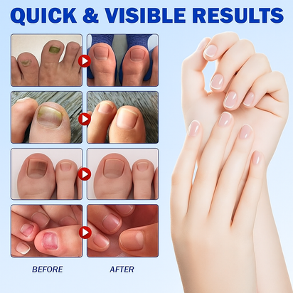 Fungal Nail Patch Treatment
